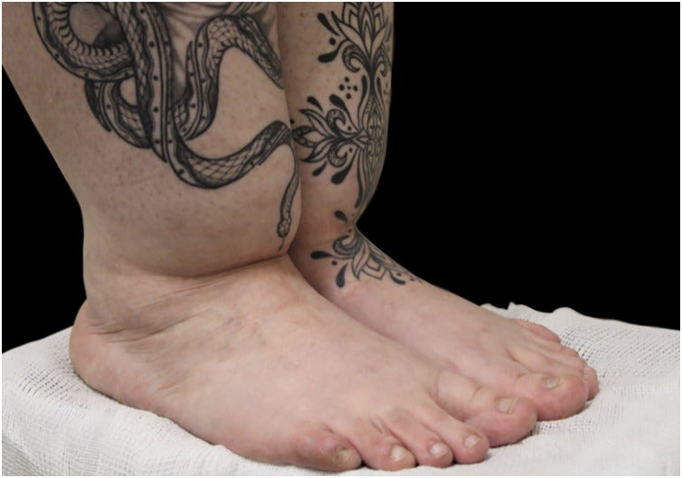 Lower legs with lipedema ending in a sharp cuff just above slim feet