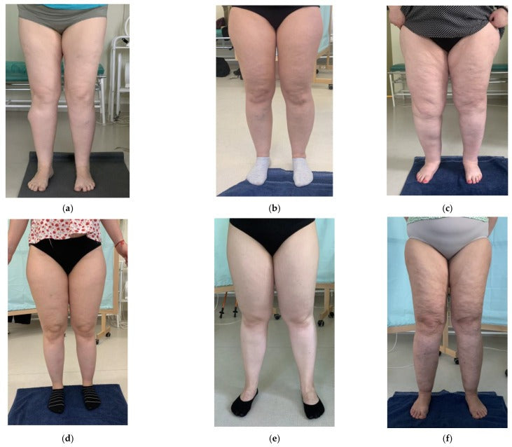 Six women with lipedema photographed front on in a clinic