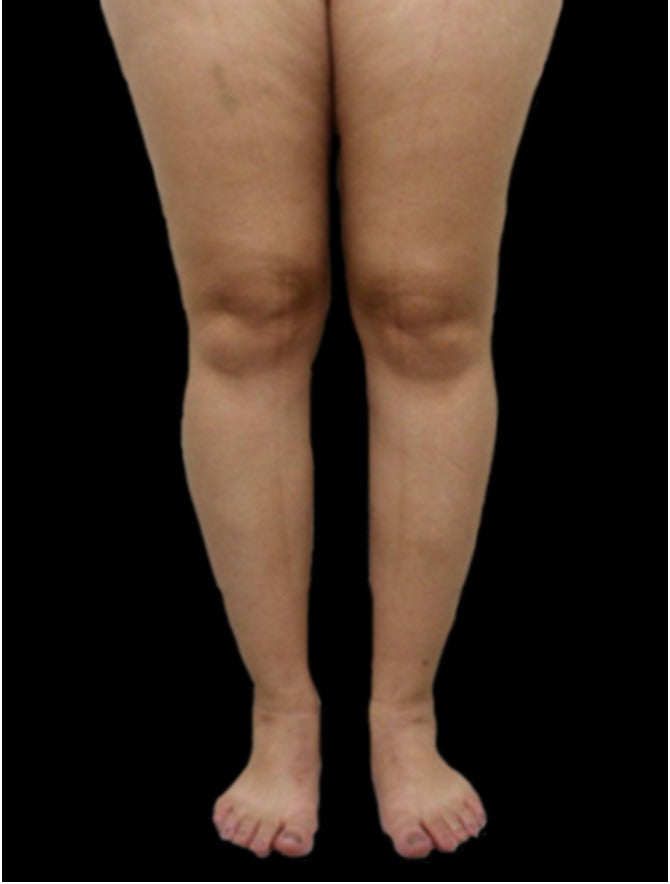 Legs with lipedema and a bruise on the upper right thigh