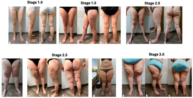 Women with lipedema at stages 1 to 3