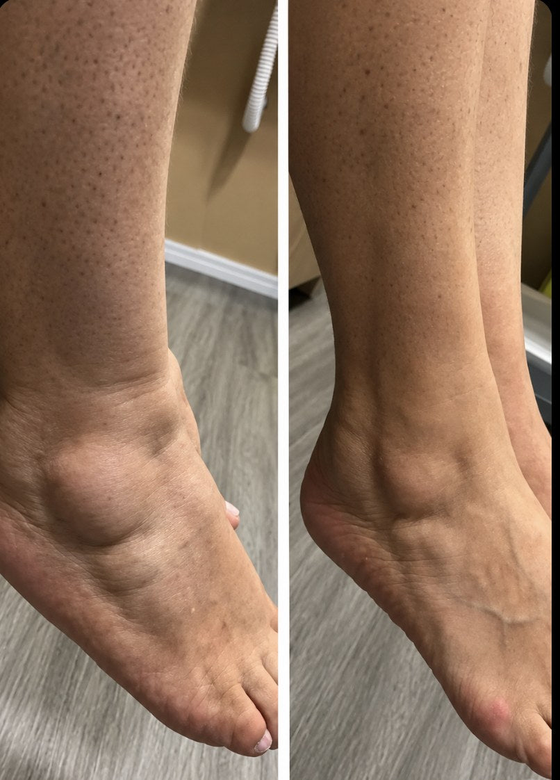 Before and after: her ankle and foot, side by side