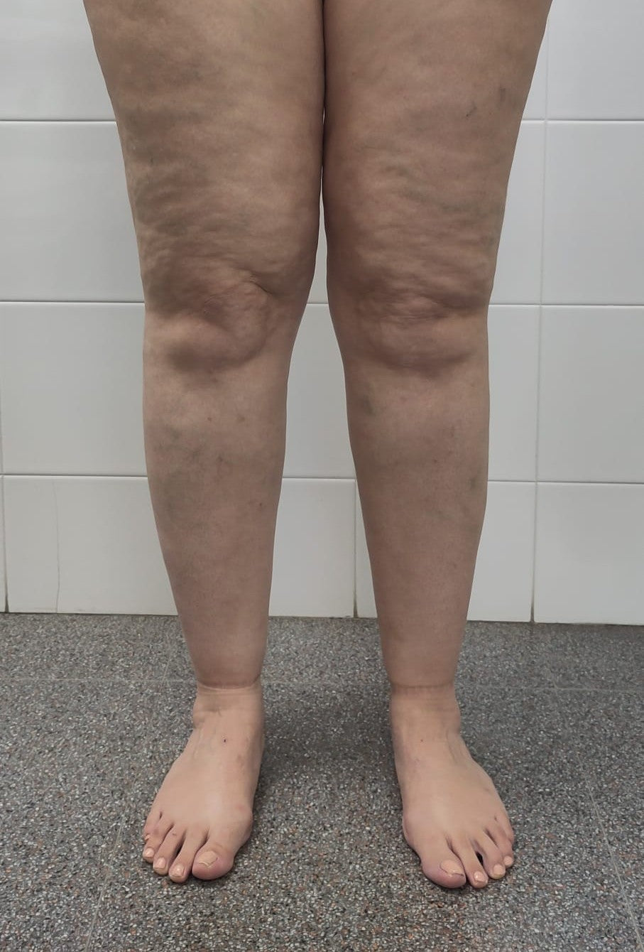A real photo of lipedema: a 42 year old woman, legs from mid thigh down, showing fuller thighs, fat pads at the knees and a cuff above the ankles